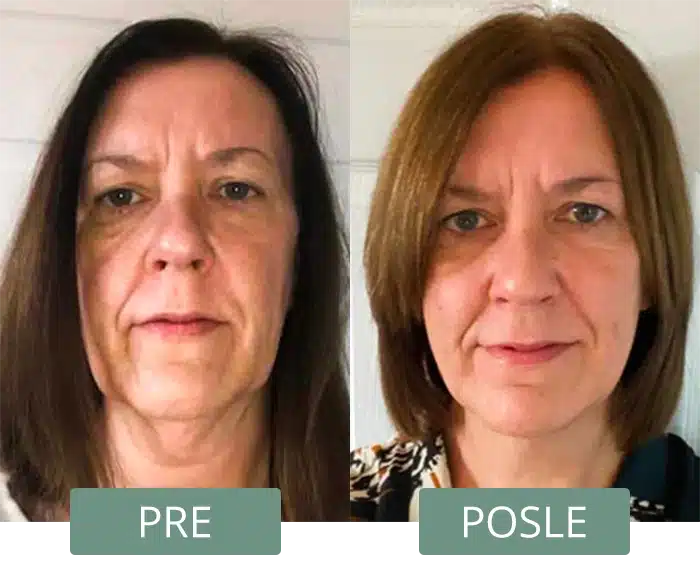 Pre i posle koriscenja collagen boost