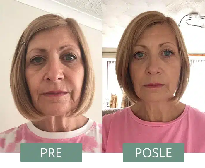 Pre i posle koriscenja collagen boost