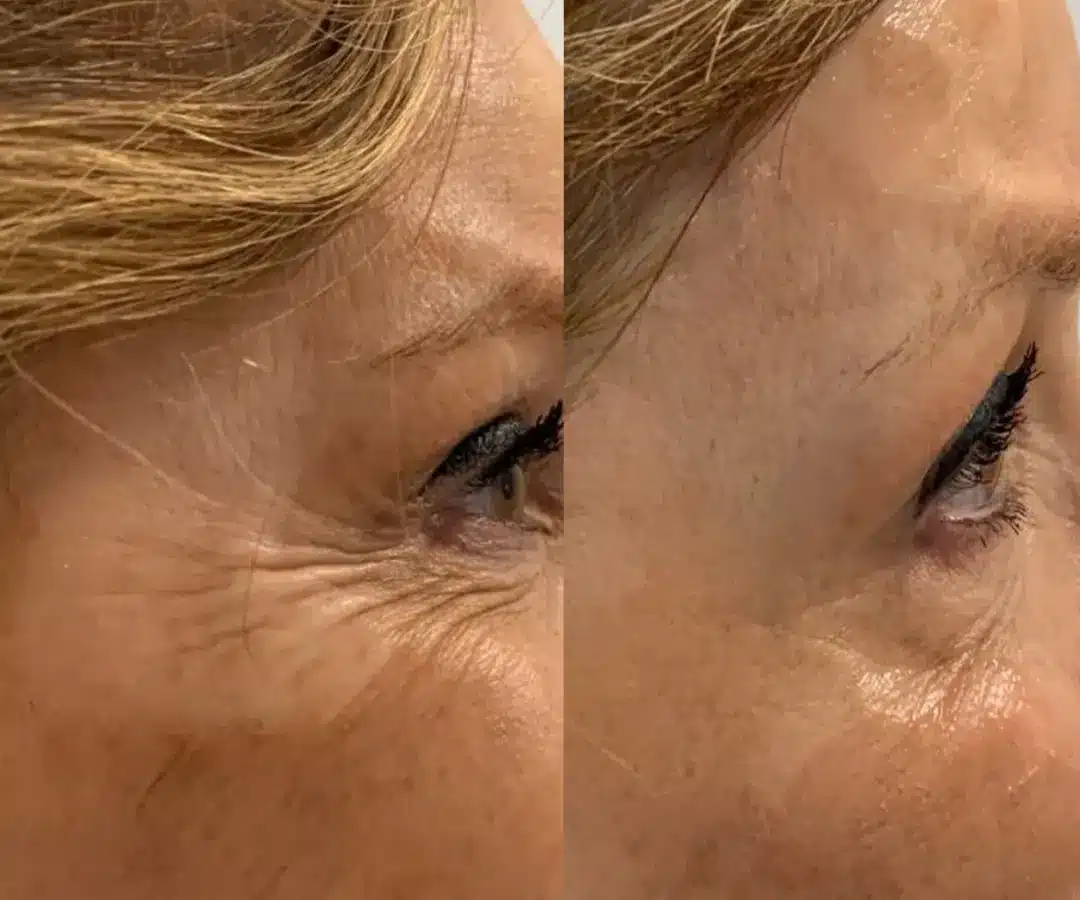 Pre i posle Collagen boost-a